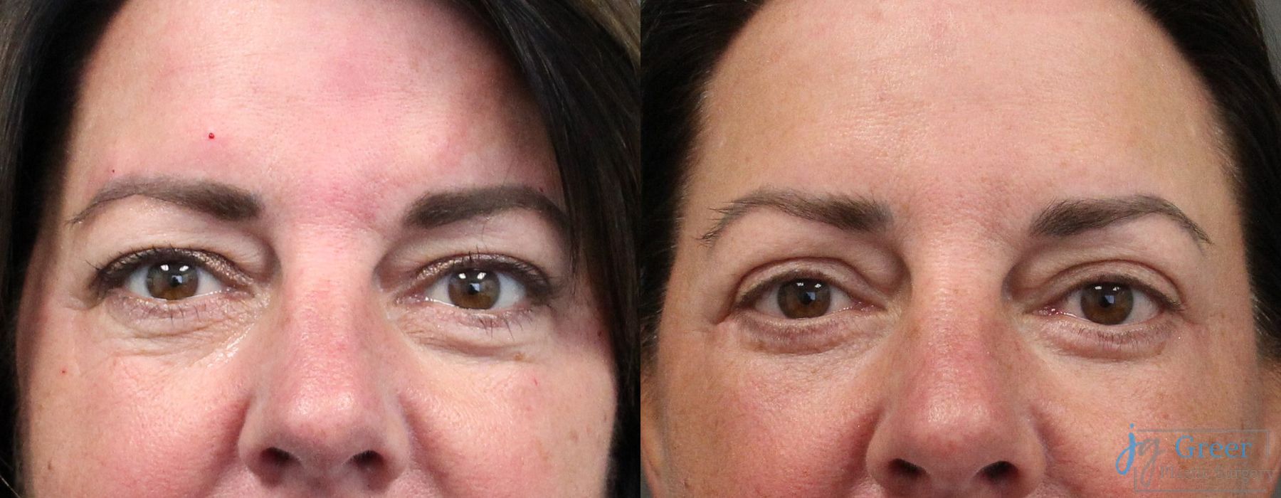 Blepharoplasty - Case 2396