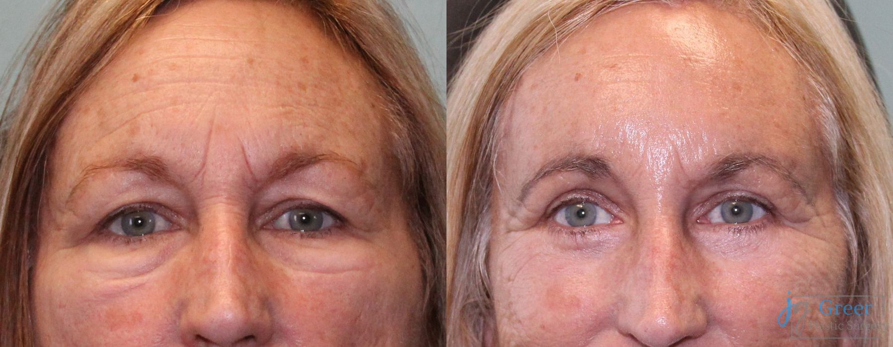 Before and after Blepharoplasty case 19891