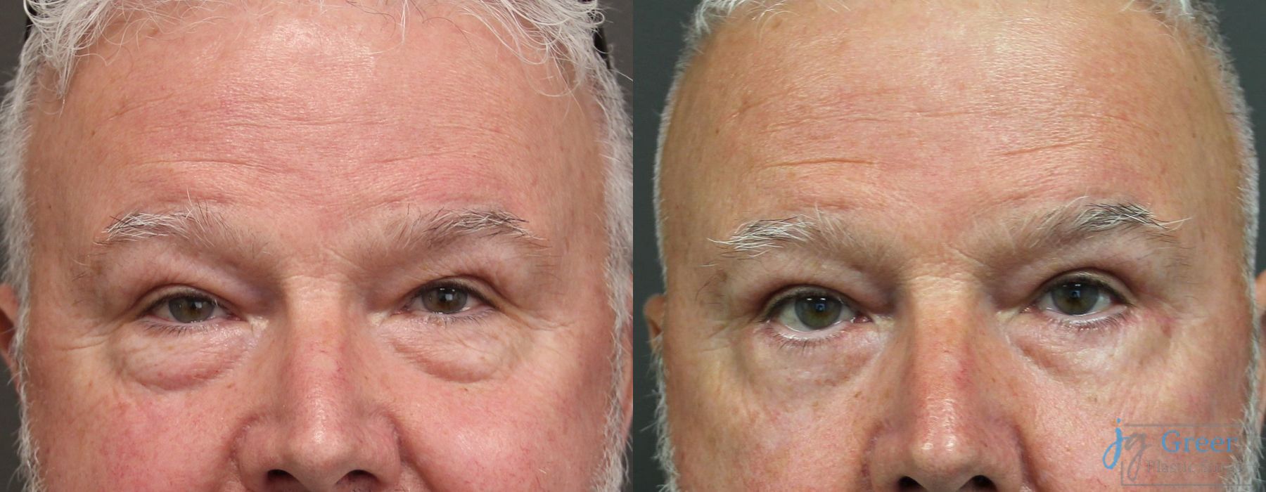 Blepharoplasty - Case 2393