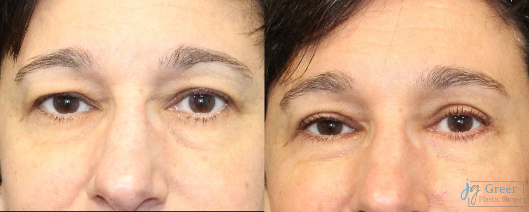 Before and after Brow Lift case 19890