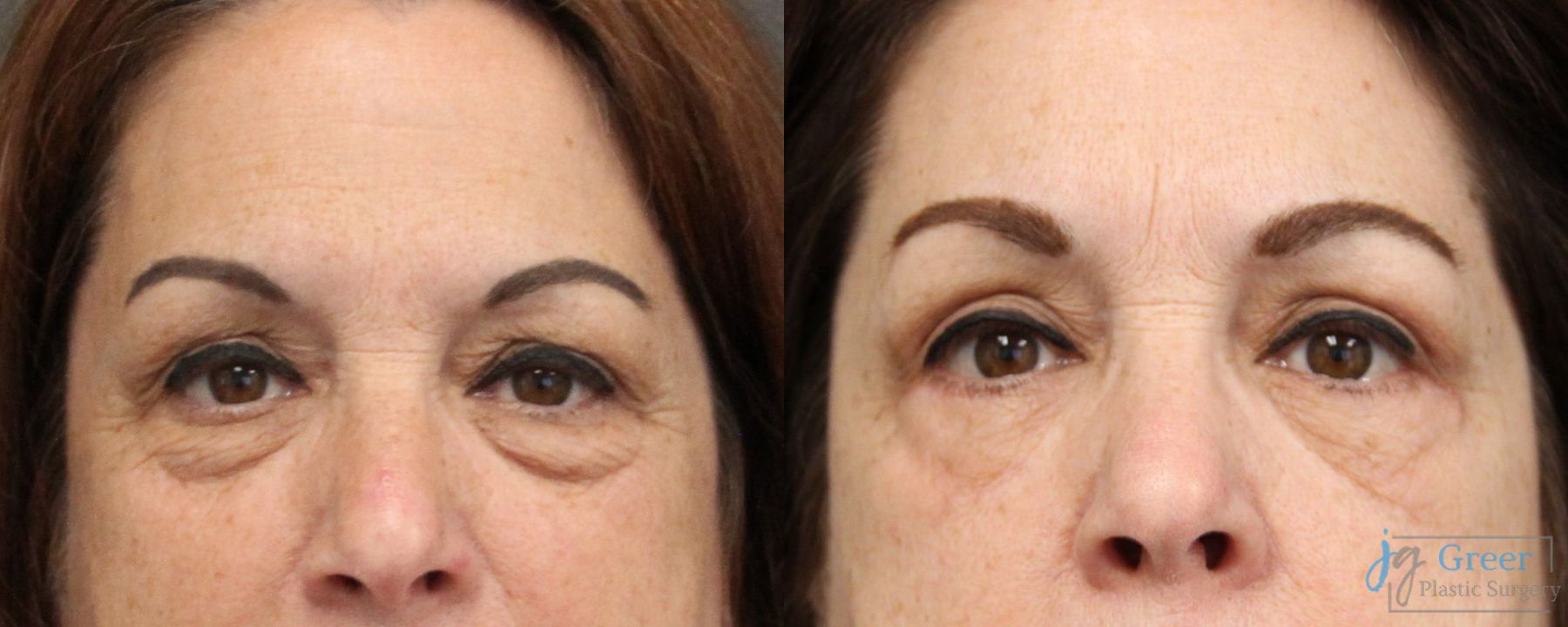 Before and after Blepharoplasty case 19887