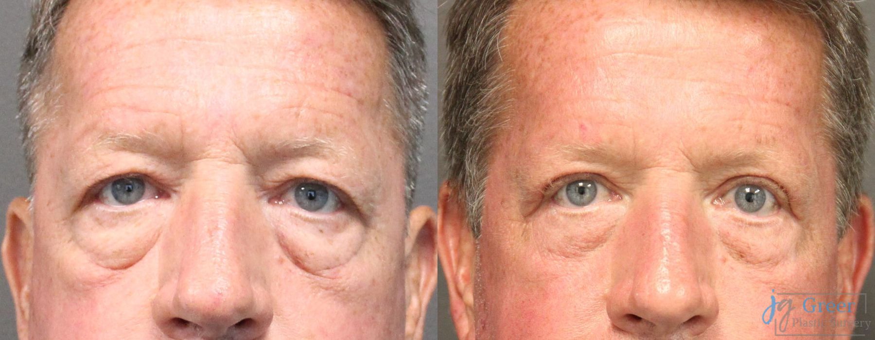 Blepharoplasty - Case 2395