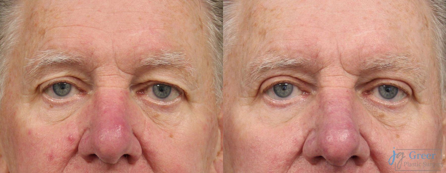 Blepharoplasty - Case 2399