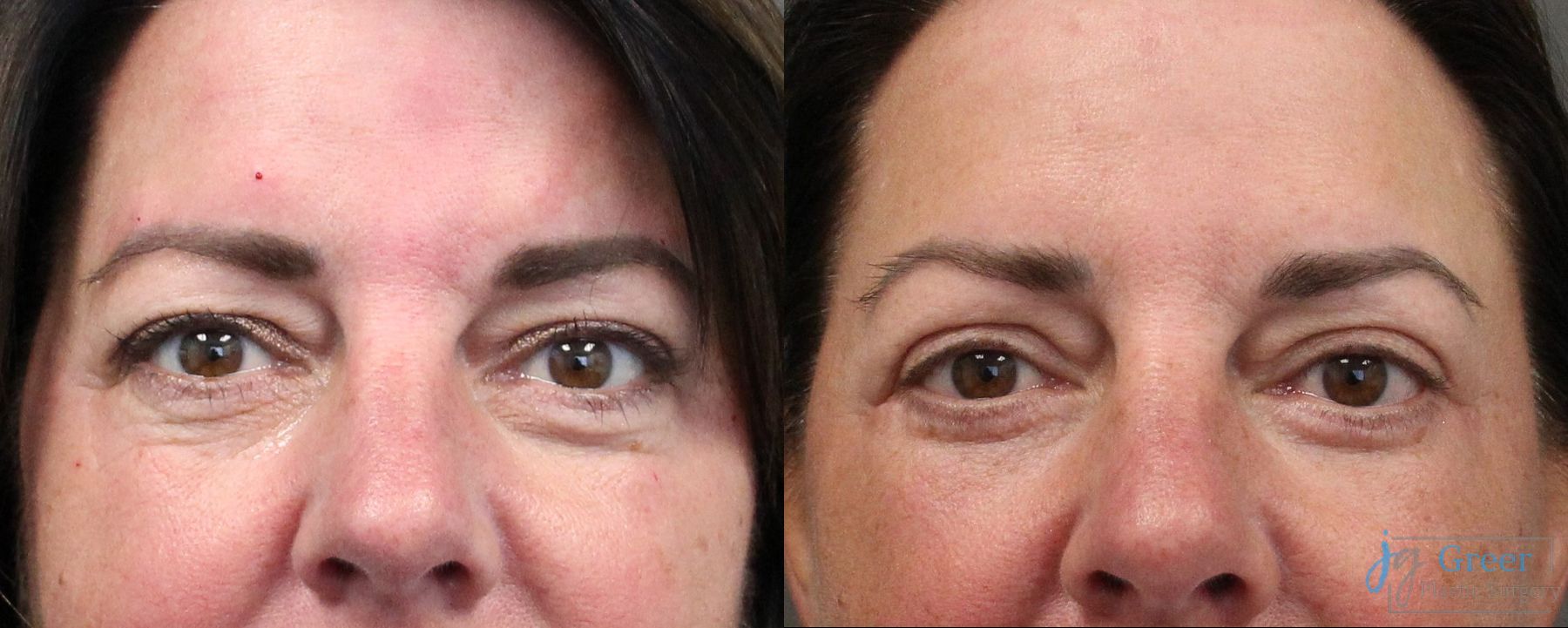 Before and after Blepharoplasty case 19886