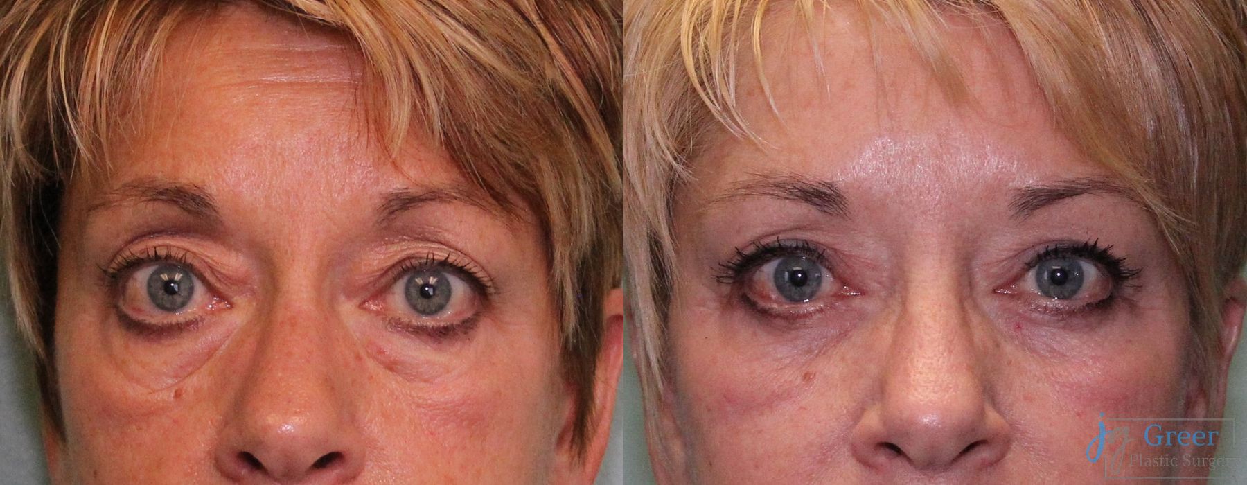 Blepharoplasty - Case 2398