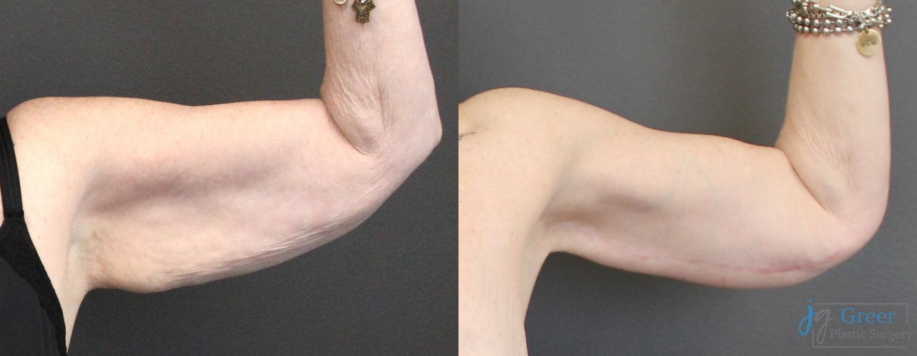 Before and after Thigh Lift case 19863 - Angle 3
