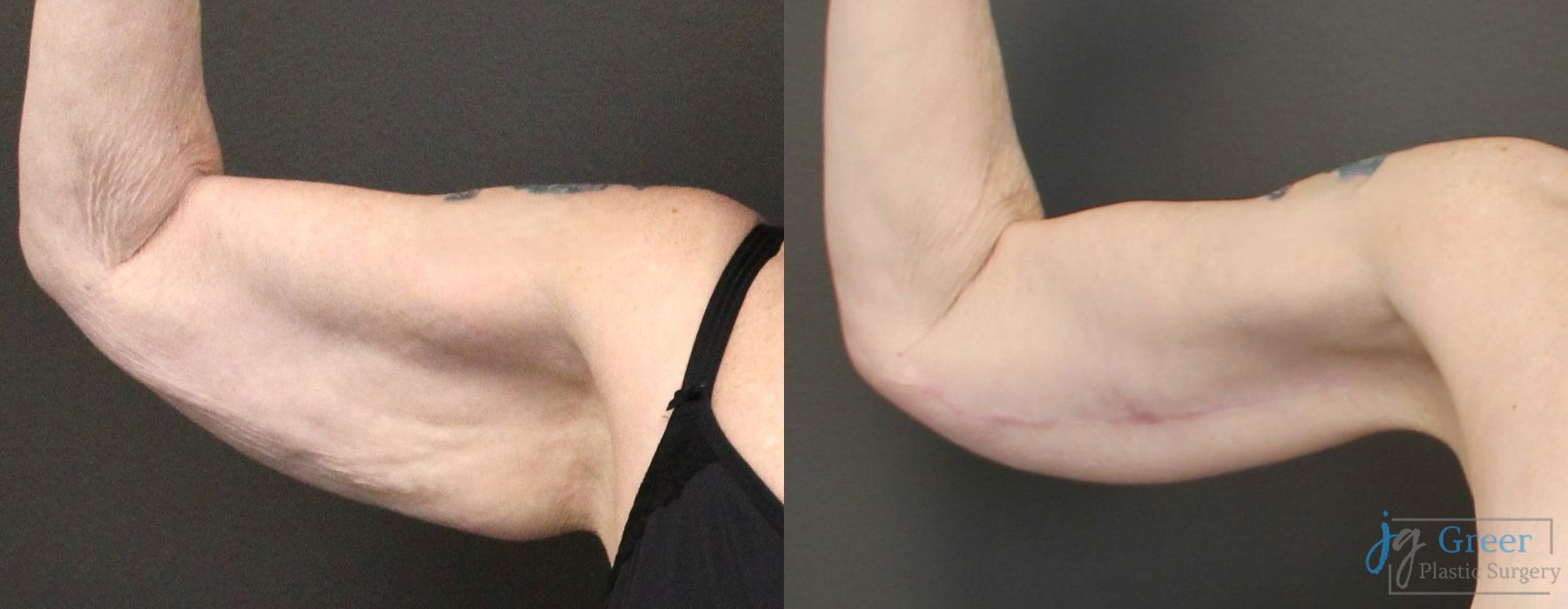 Before and after Thigh Lift case 19863 - Angle 2