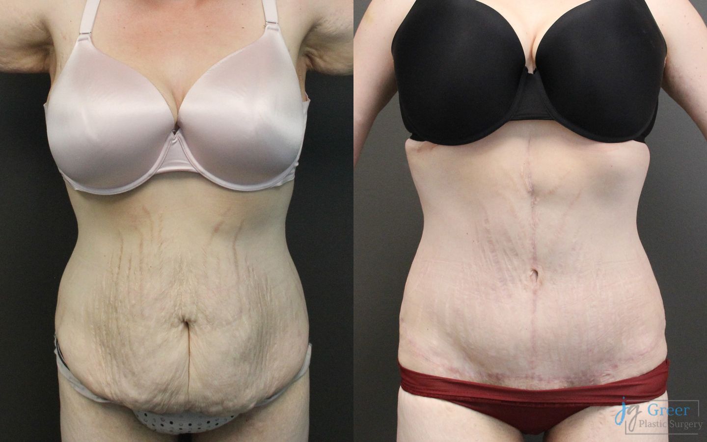 Before and after Fleur-de-Lis Abdominoplasty case 19851 - Angle 3