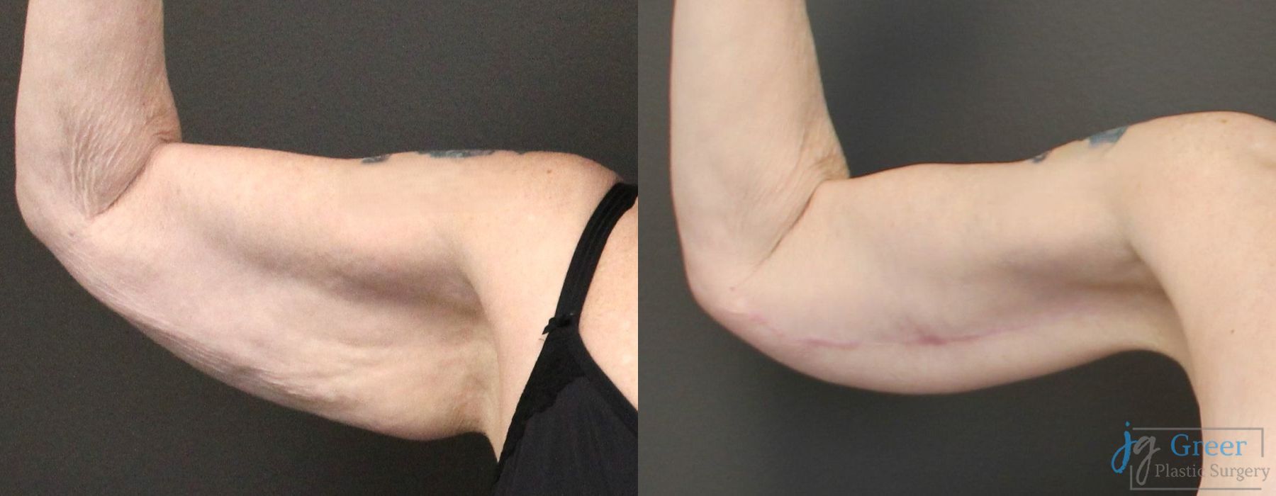 Brachioplasty - Case 2345