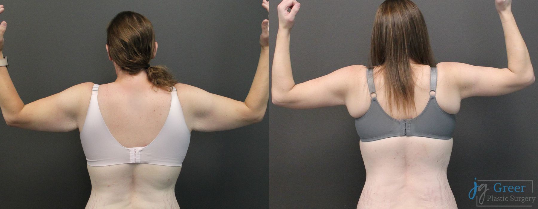 Abdominoplasty - Thumbnail 2