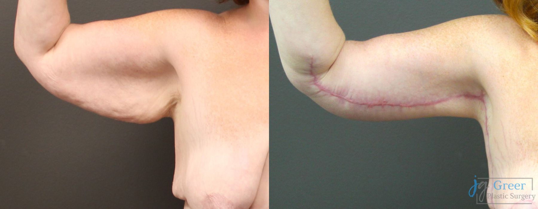 Before and after Brachioplasty case 19855 - Angle 2