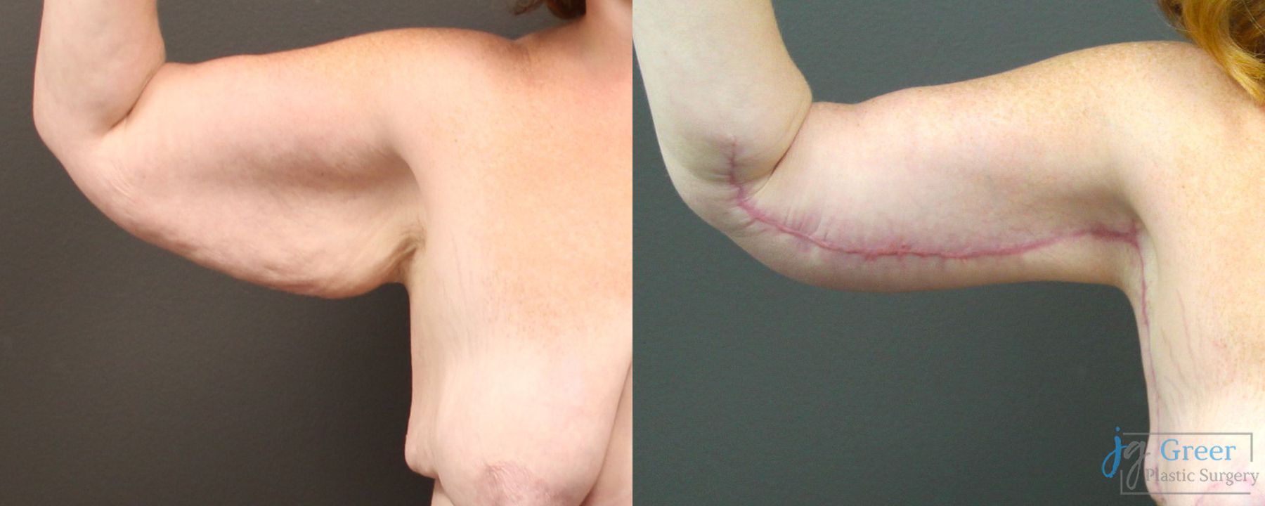Before and after Brachioplasty case 19855 - Angle 2