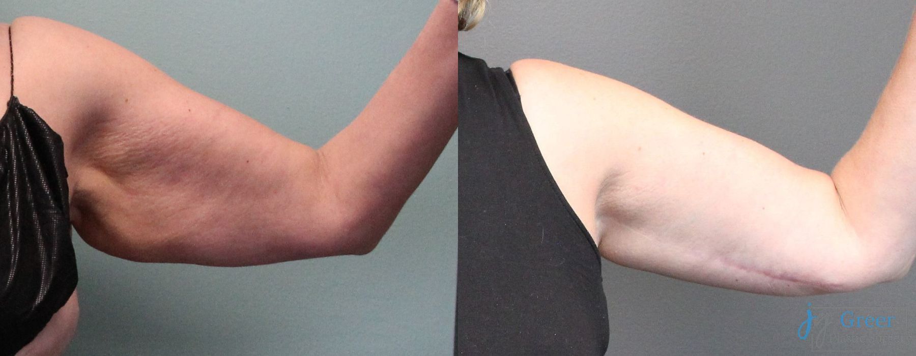 Brachioplasty - Thumbnail 3