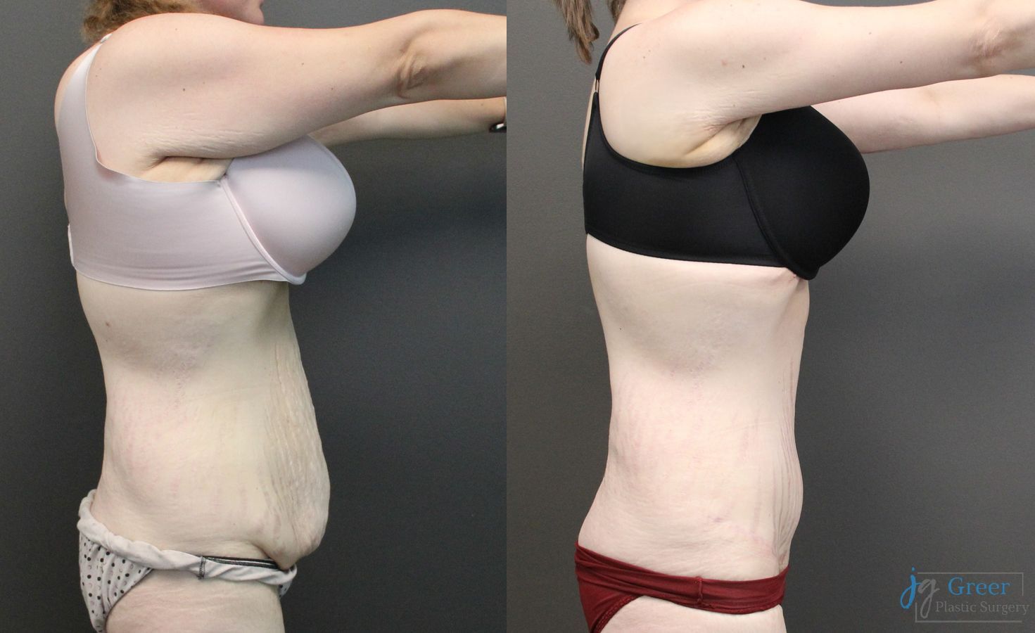 Before and after Fleur-de-Lis Abdominoplasty case 19851 - Angle 4