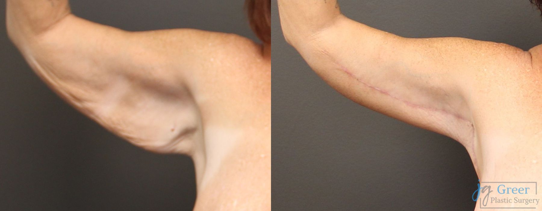 Before photo - Angle 2