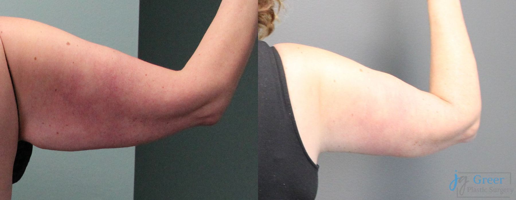Brachioplasty - Thumbnail 2