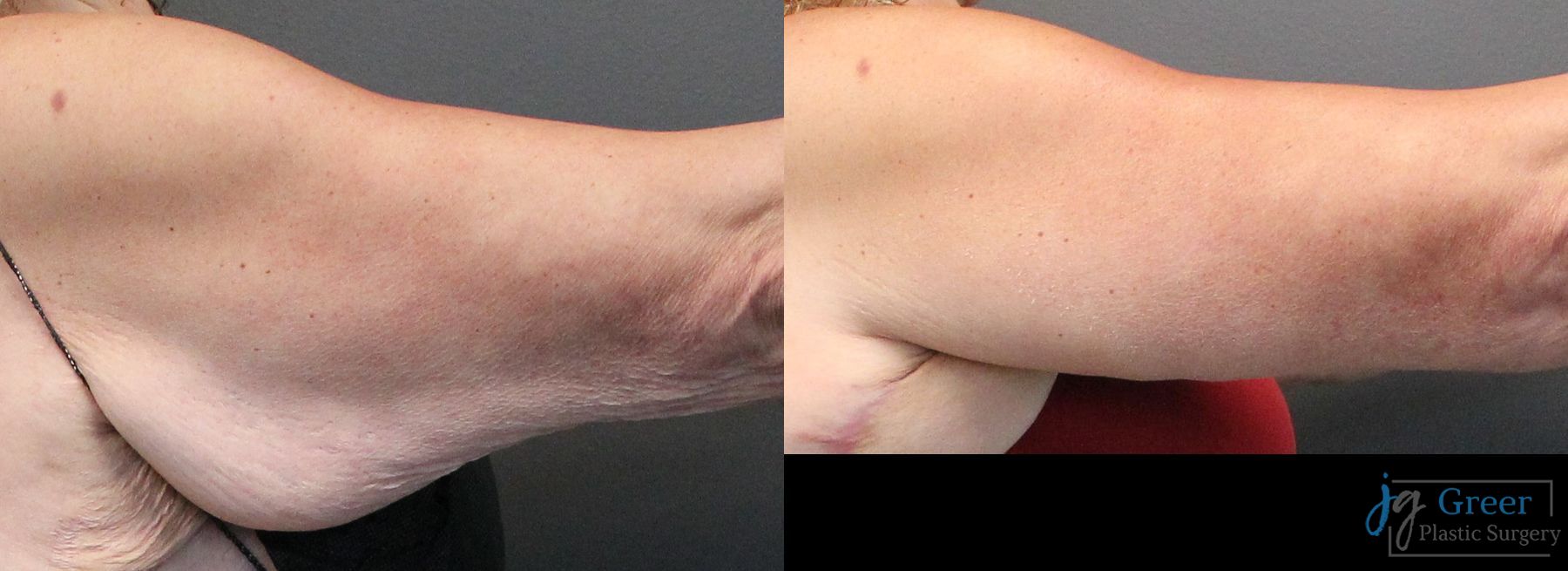Before and after Brachioplasty case 19857