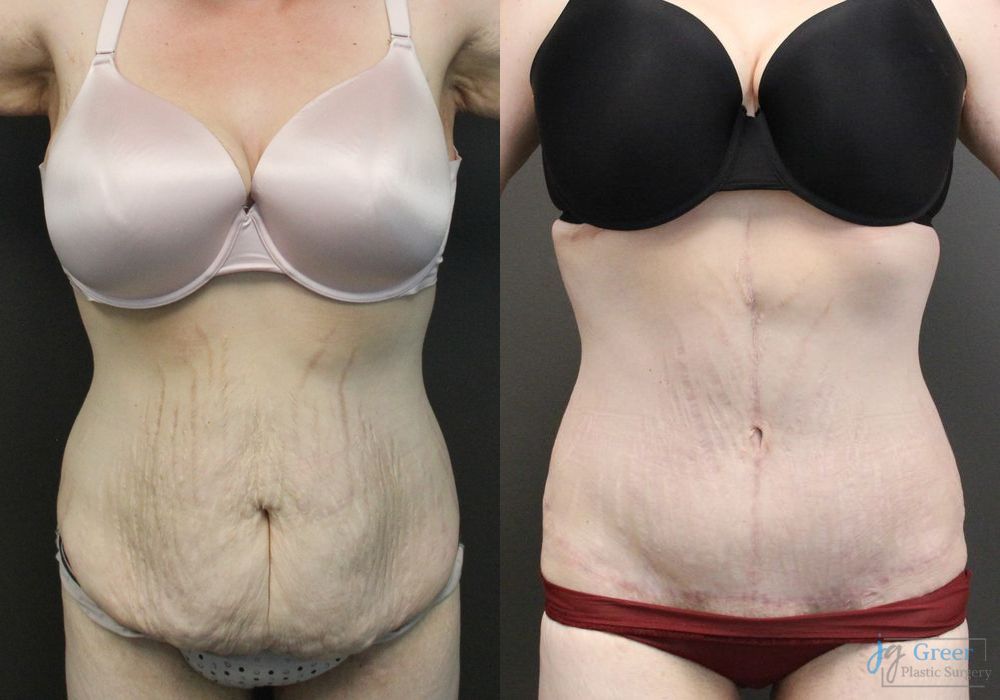 Before and after Brachioplasty case 19851 - Angle 3