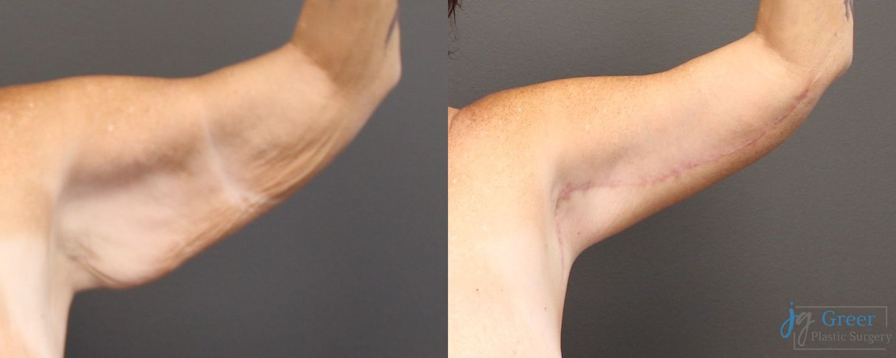 Before and after Brachioplasty case 19862