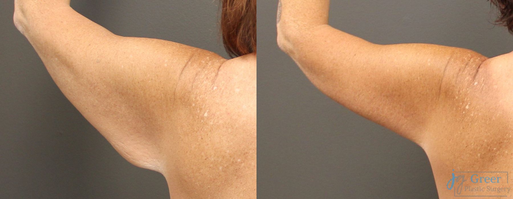 Before photo - Angle 4