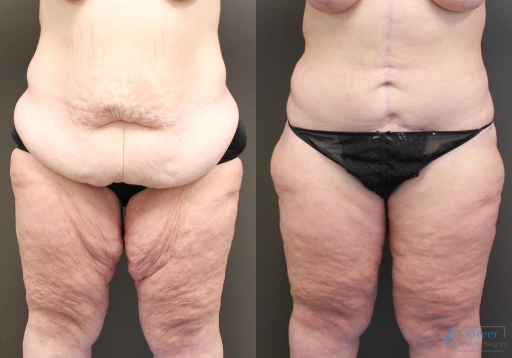 Before and after Brachioplasty case 19855