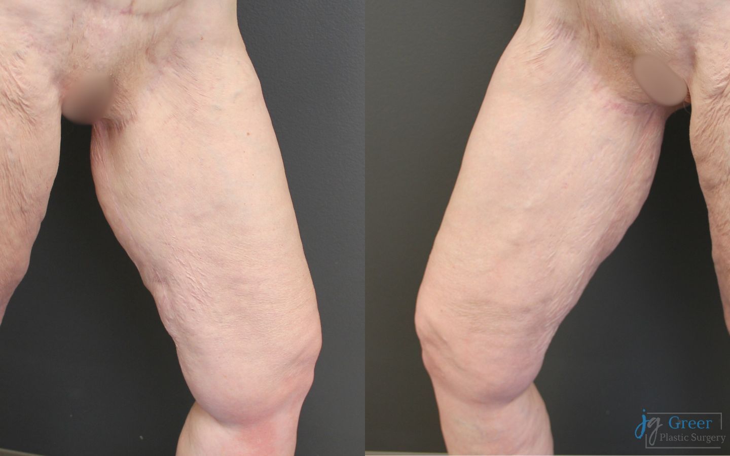 Before and after Brachioplasty case 19863 - Angle 4