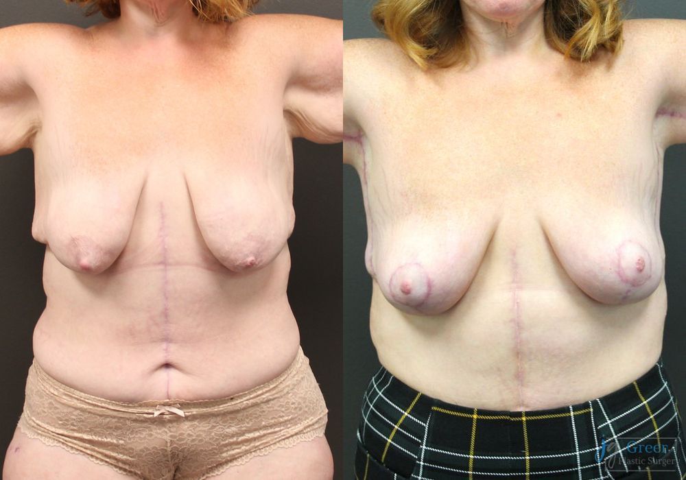 Before and after Brachioplasty case 19855 - Angle 5