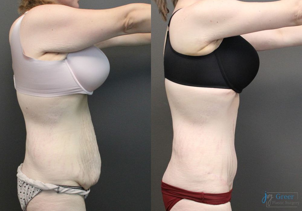 Before and after Brachioplasty case 19851 - Angle 4