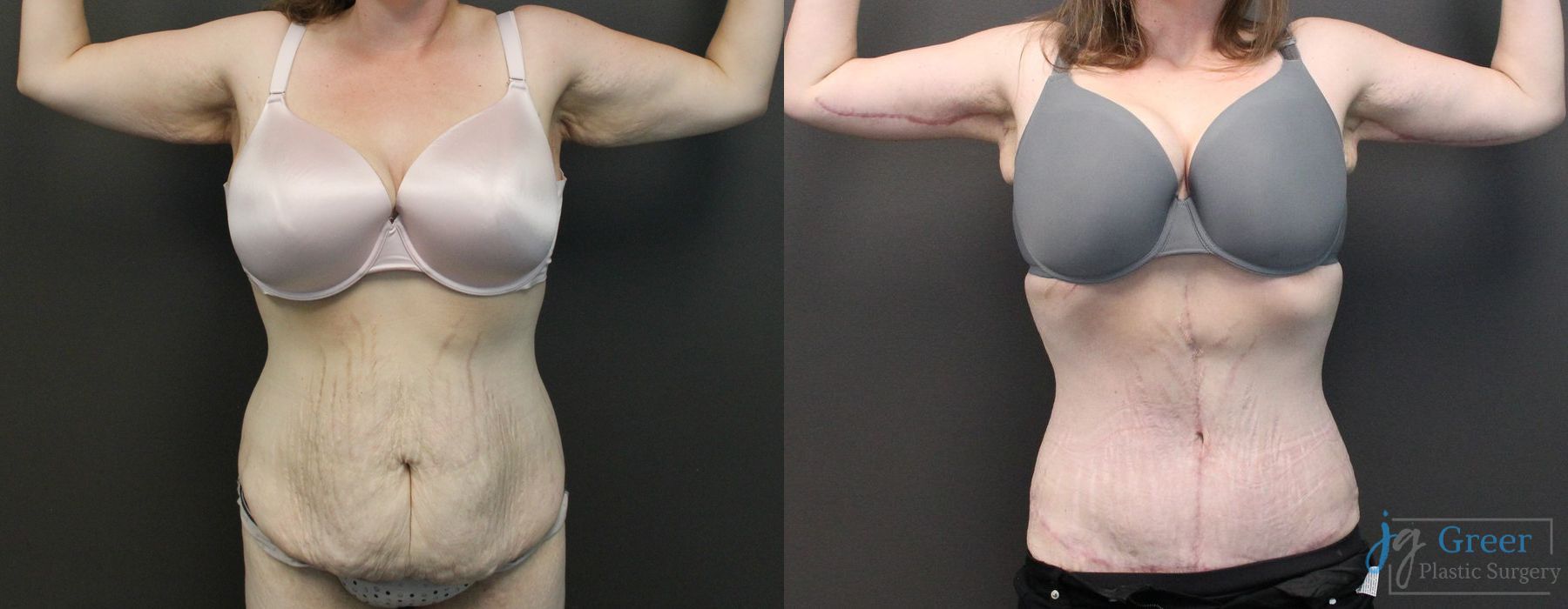 Before and after Brachioplasty case 19851