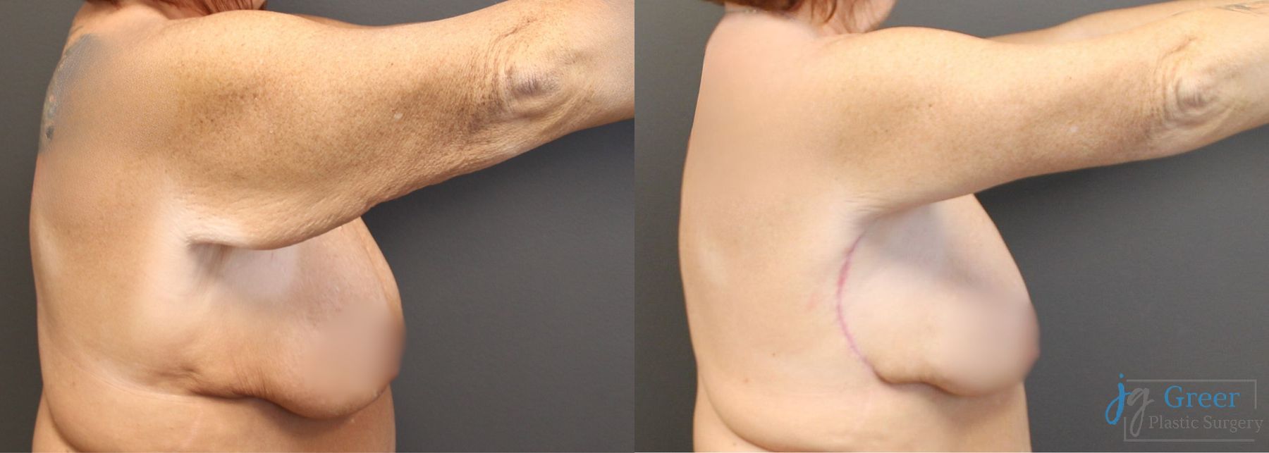 Before and after Brachioplasty case 19862 - Angle 5
