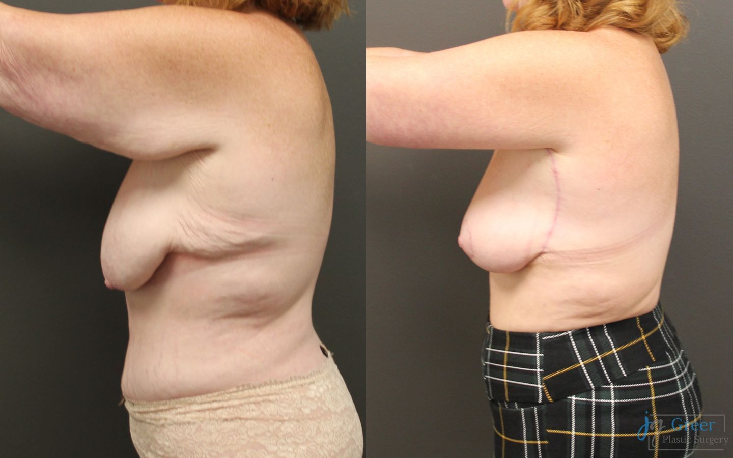 Before and after Brachioplasty case 19855 - Angle 4