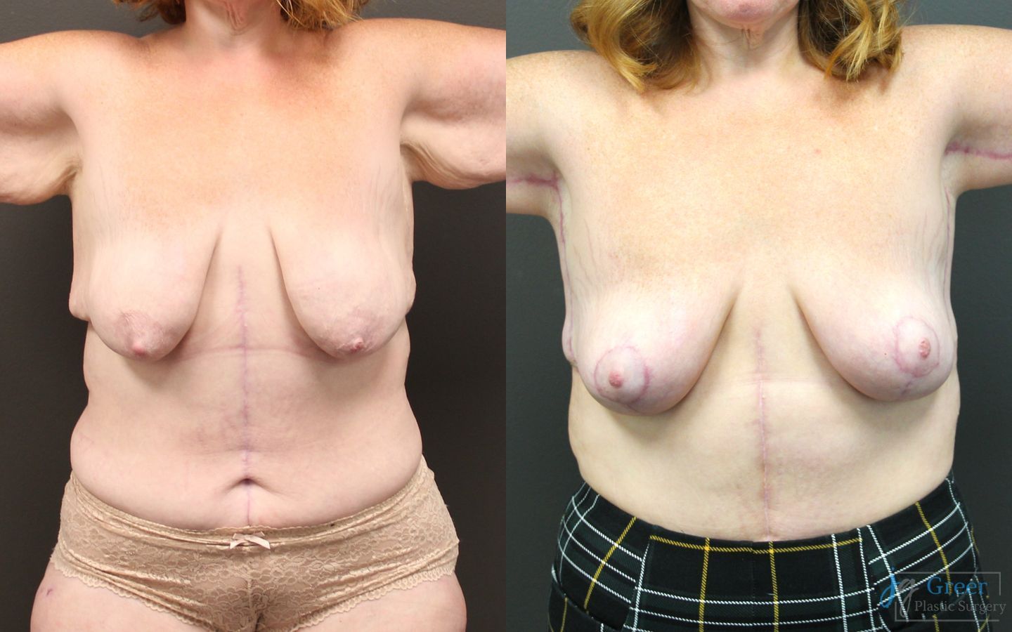 Before and after Brachioplasty case 19855 - Angle 5