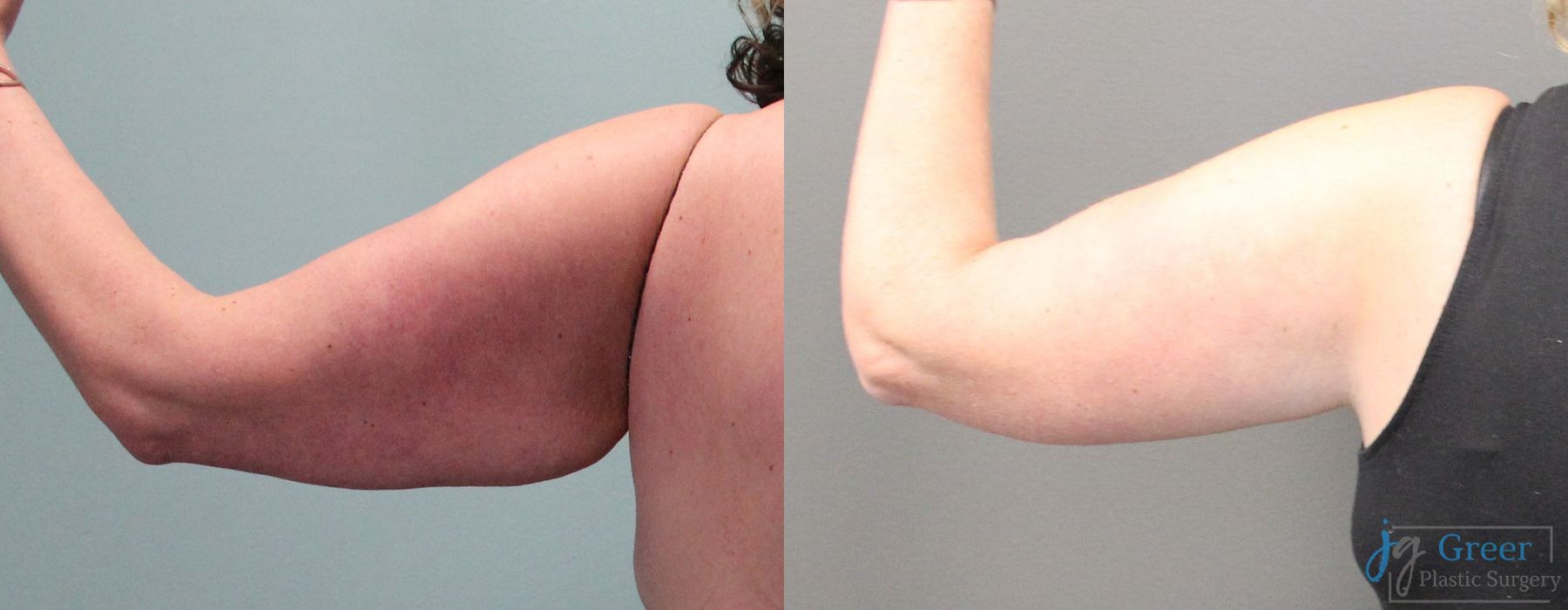 Brachioplasty - Thumbnail 4