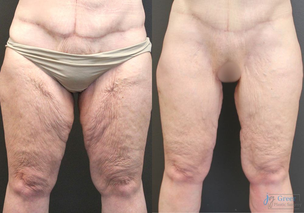 Before and after Thigh Lift case 19863