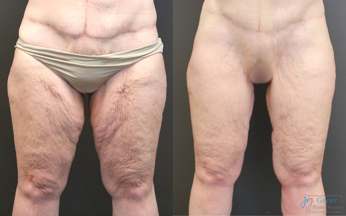 Before and after Brachioplasty case 19863