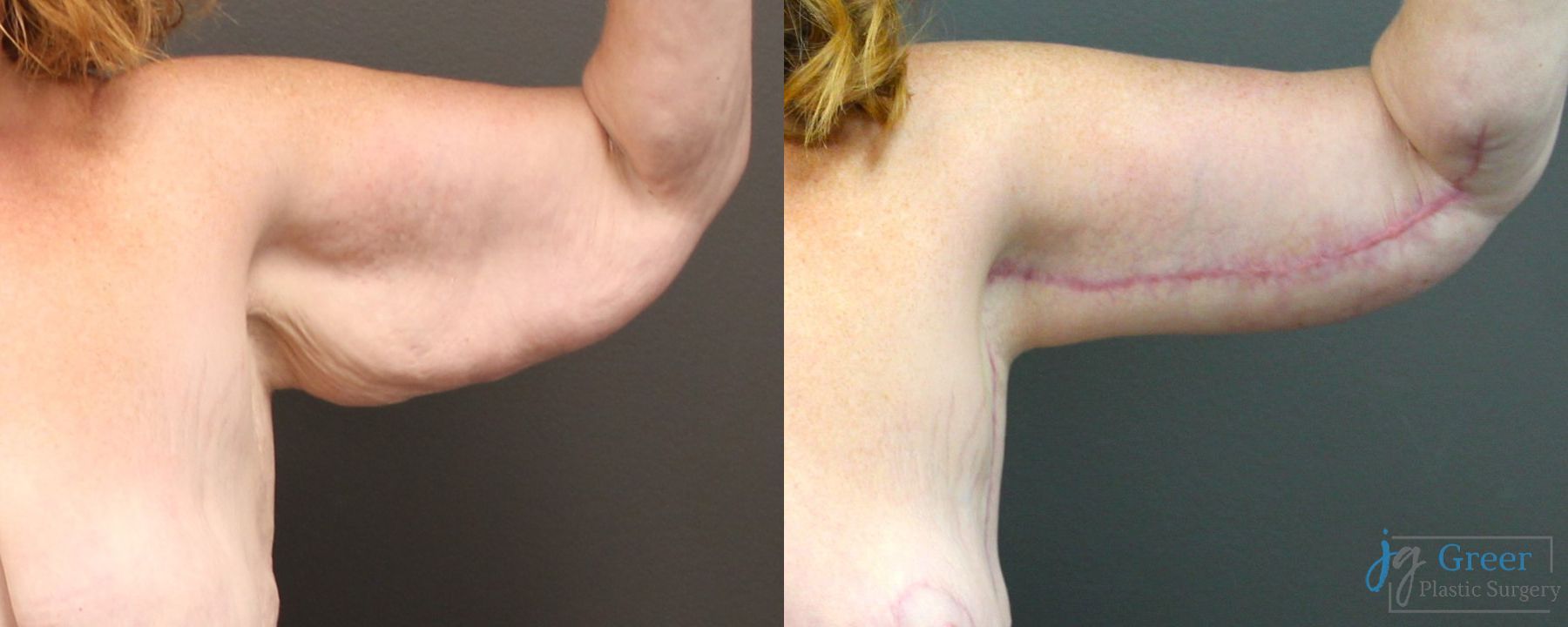 Before and after Brachioplasty case 19855 - Angle 3