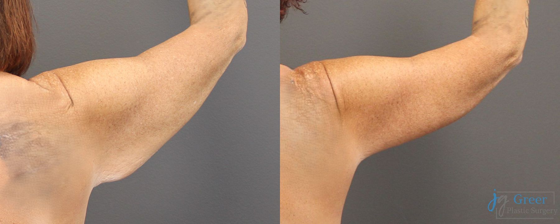 Before and after Brachioplasty case 19862 - Angle 3