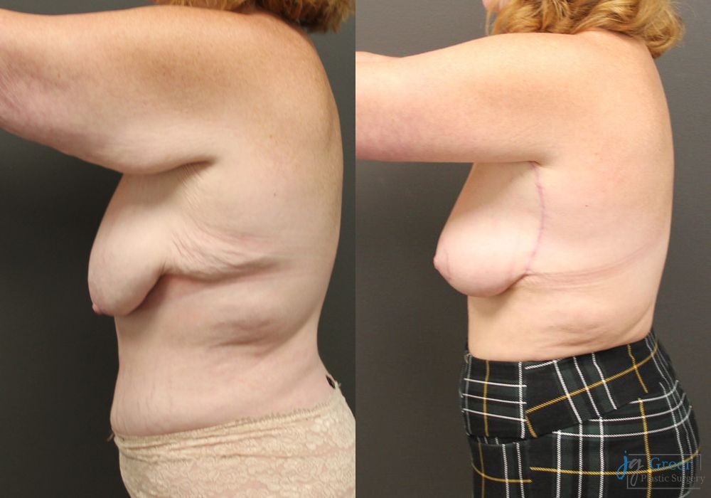 Before and after Brachioplasty case 19855 - Angle 4