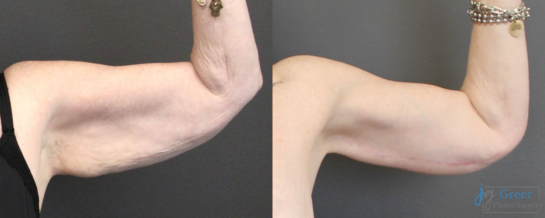 Before and after Brachioplasty case 19863 - Angle 3
