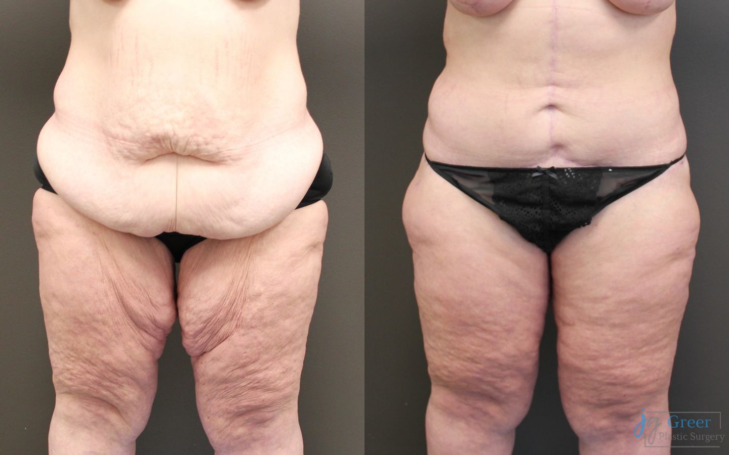 Before and after Brachioplasty case 19855