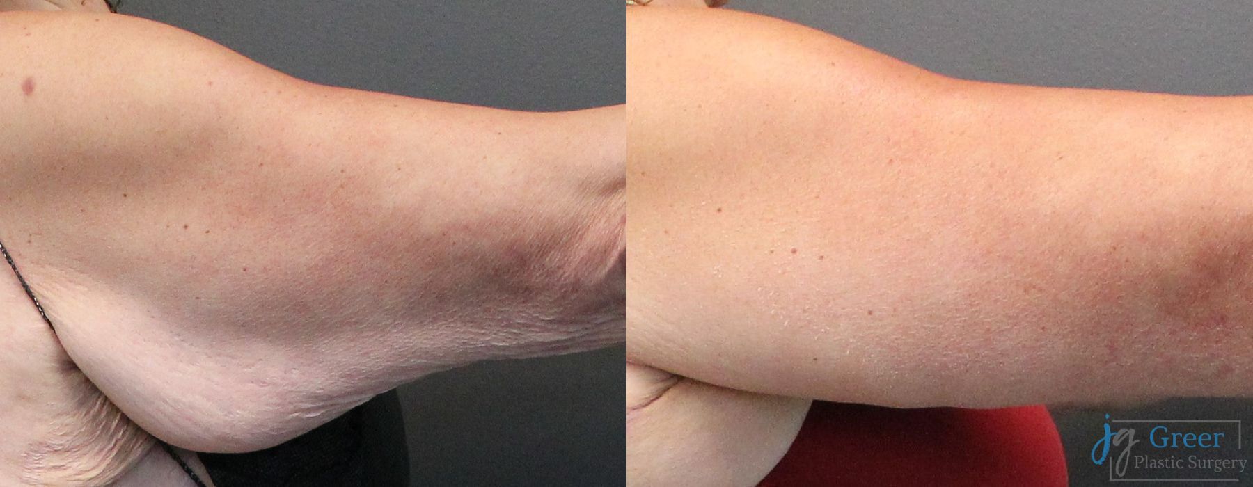 Brachioplasty - Case 2305