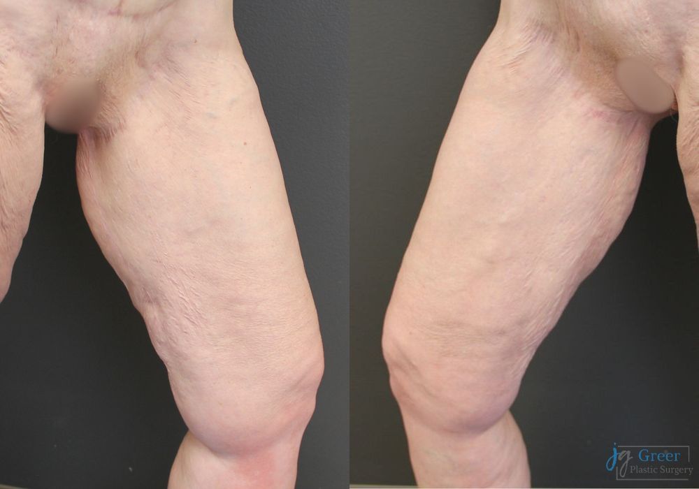 Before and after Thigh Lift case 19863 - Angle 4