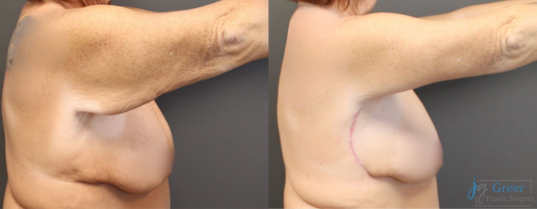 Before photo - Angle 5