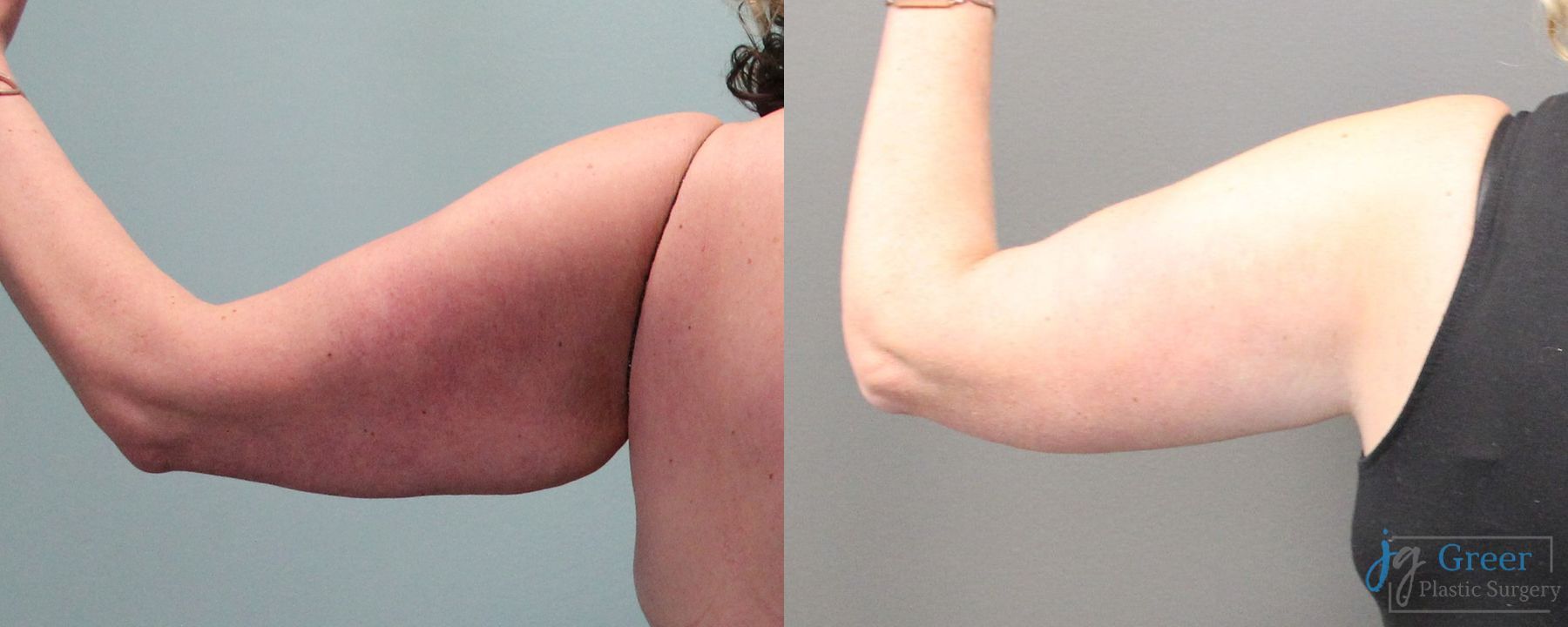 Before and after Brachioplasty case 19860 - Angle 4