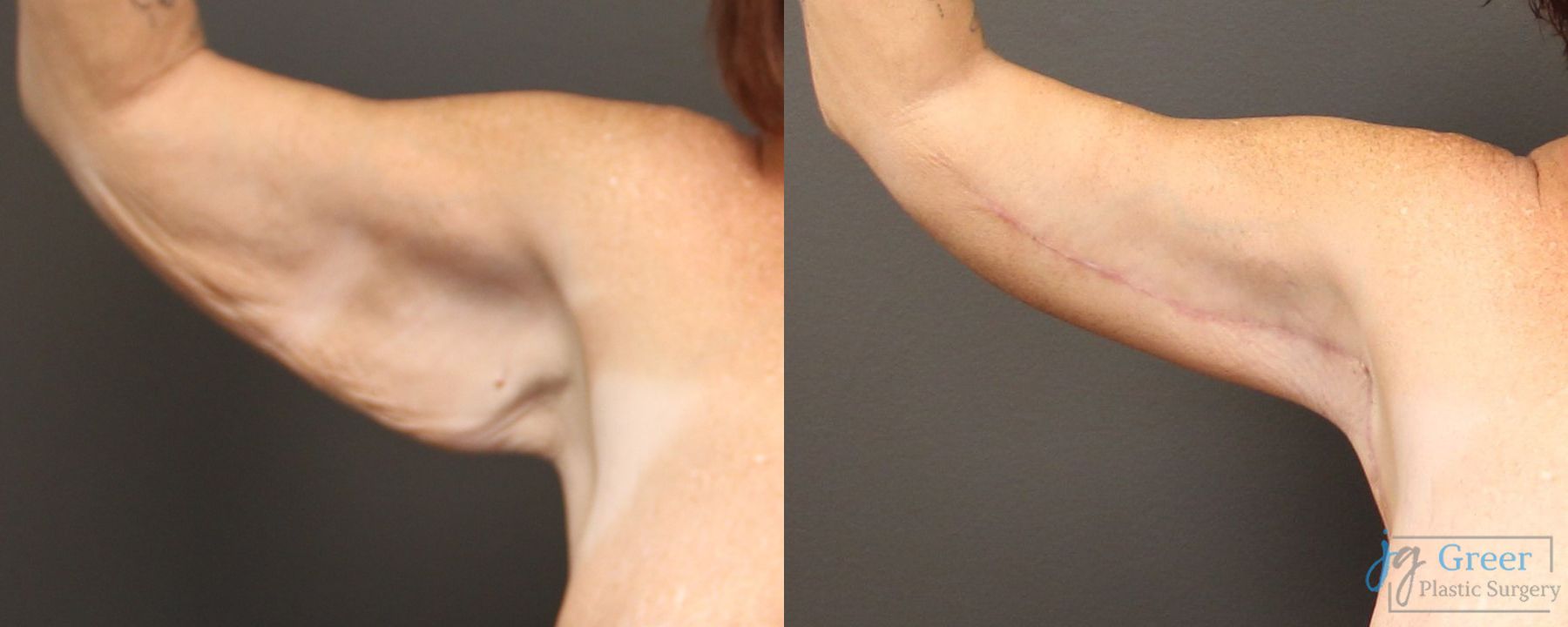 Before and after Brachioplasty case 19862 - Angle 2