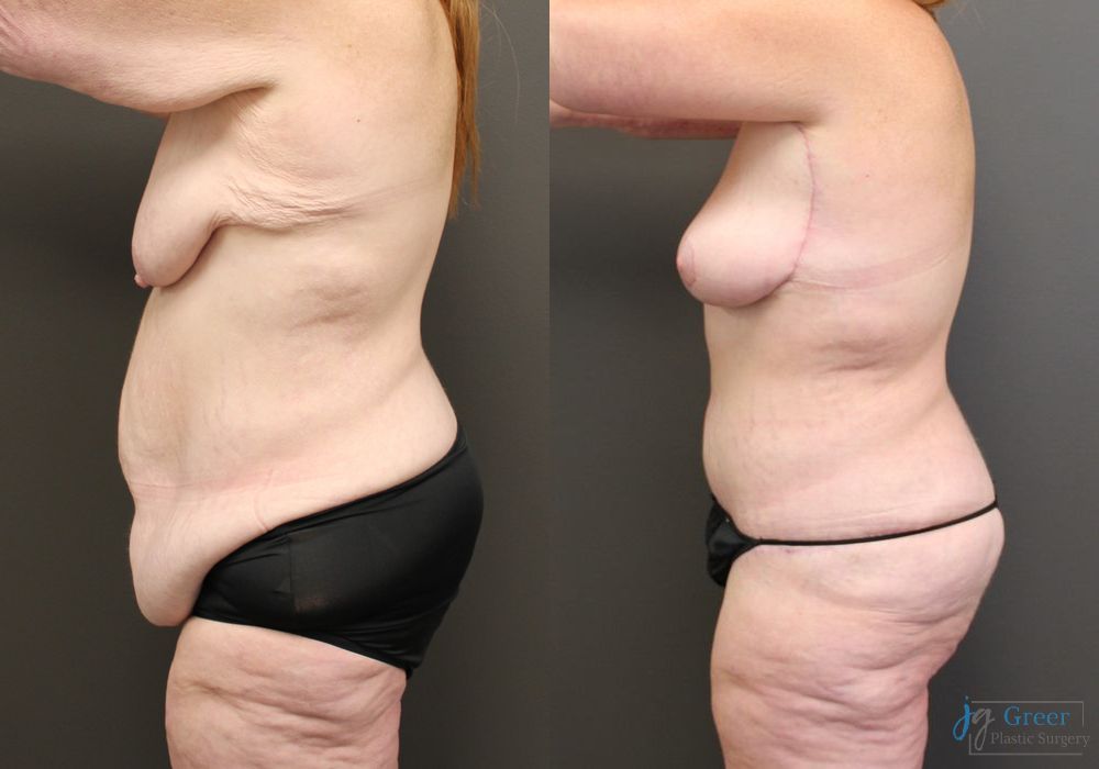 Before and after Brachioplasty case 19855 - Angle 6