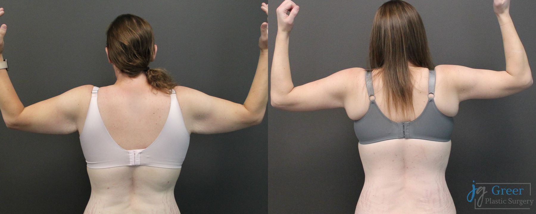 Before and after Fleur-de-Lis Abdominoplasty case 19851 - Angle 2