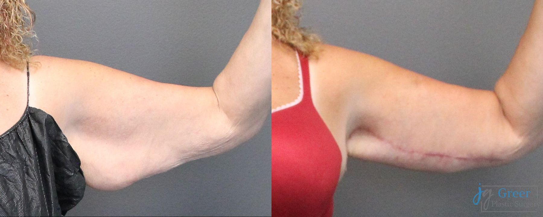 Before and after Brachioplasty case 19857 - Angle 3