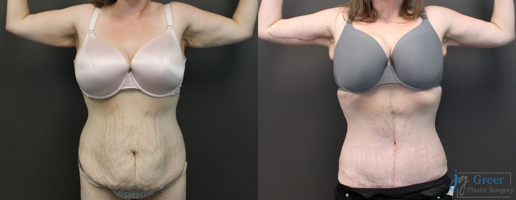 Abdominoplasty - Case 2303