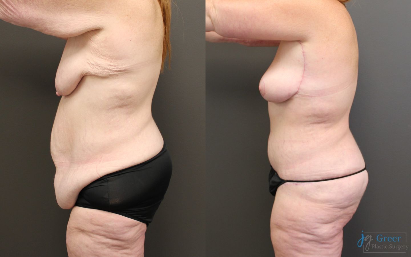 Before and after Brachioplasty case 19855 - Angle 6
